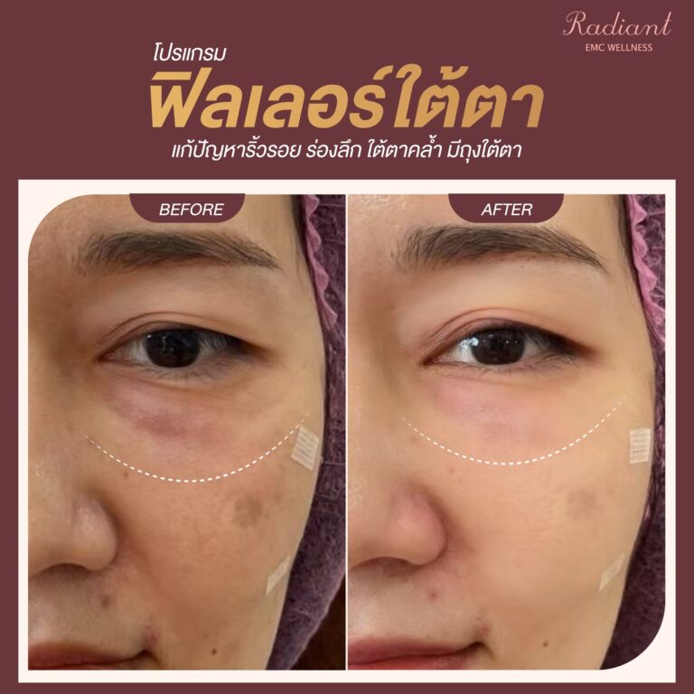 ฟิลเลอร์ใต้ตา