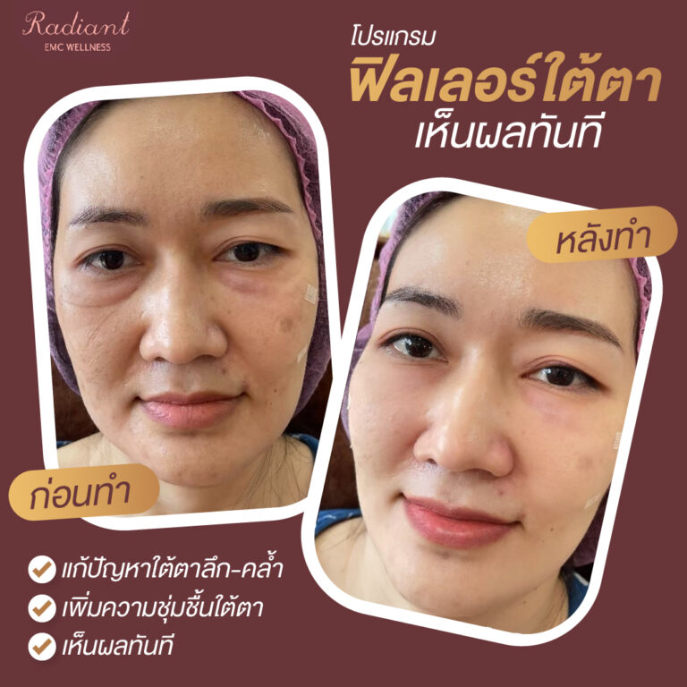 ใต้ตาคล้ำ