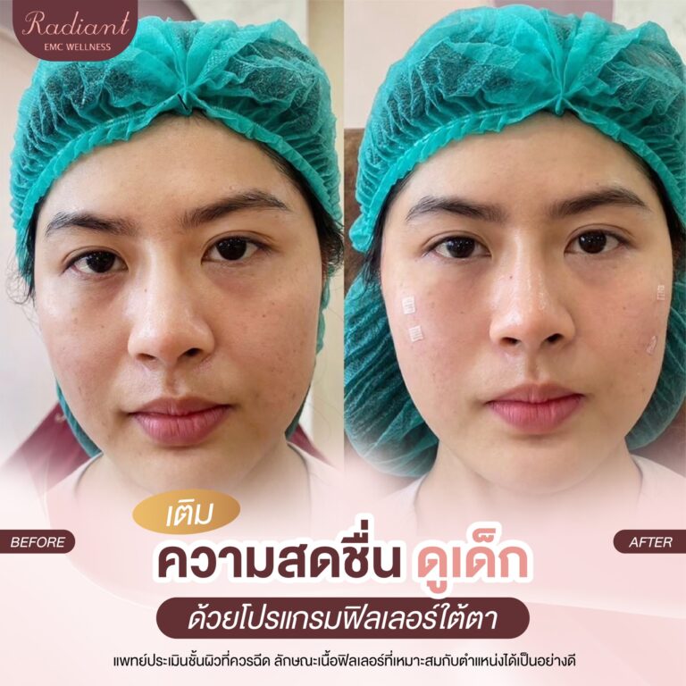 ฟิลเลอร์ใต้ตา