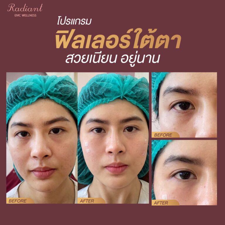 ใต้ตาดำคล้ำ