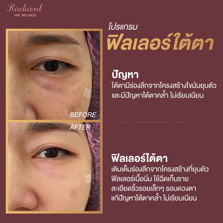 ฟิลเลอร์ใต้ตา