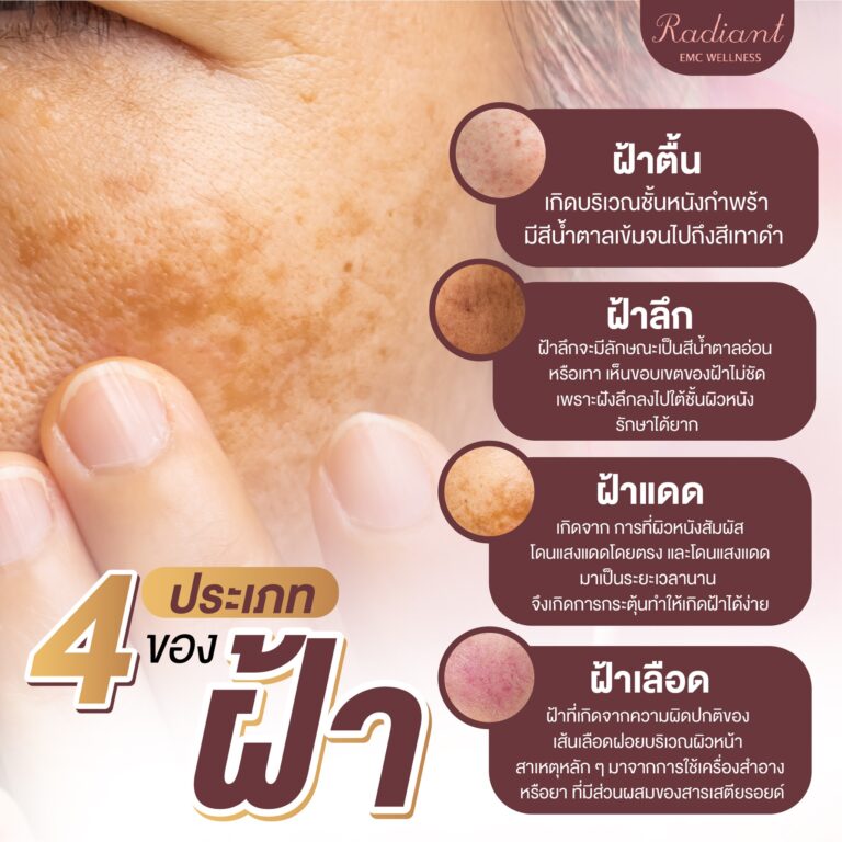 ประเภทของฝ้า