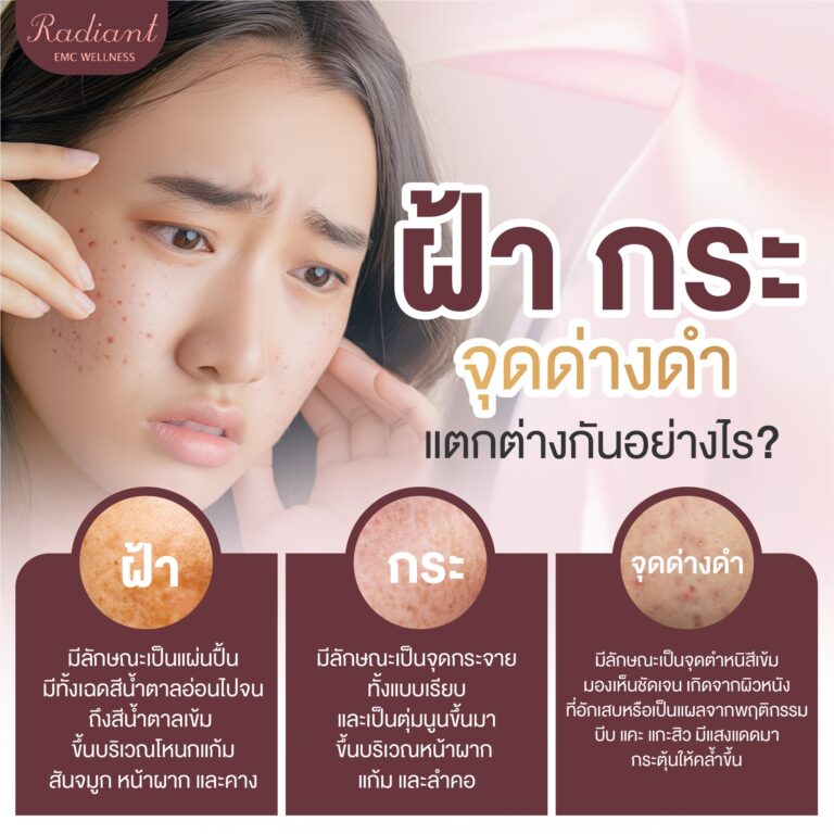 ฝ้า กระ จุดด่างดำ