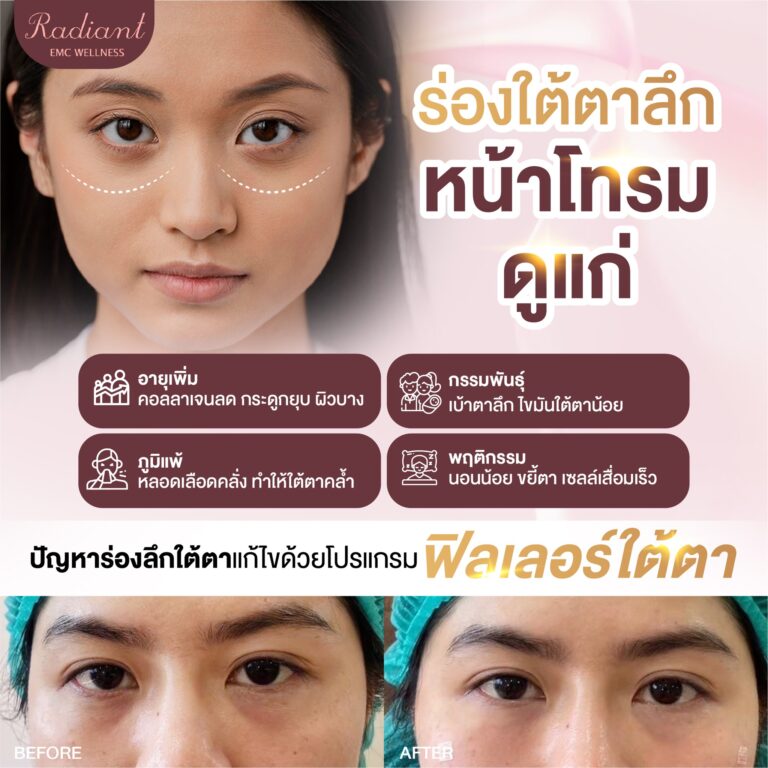 ร่องใต้ตาลึก