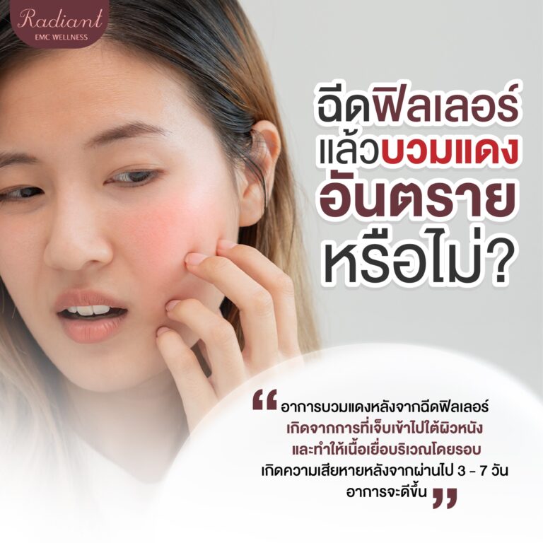 ฉีดฟิลเลอร์แล้วบวม