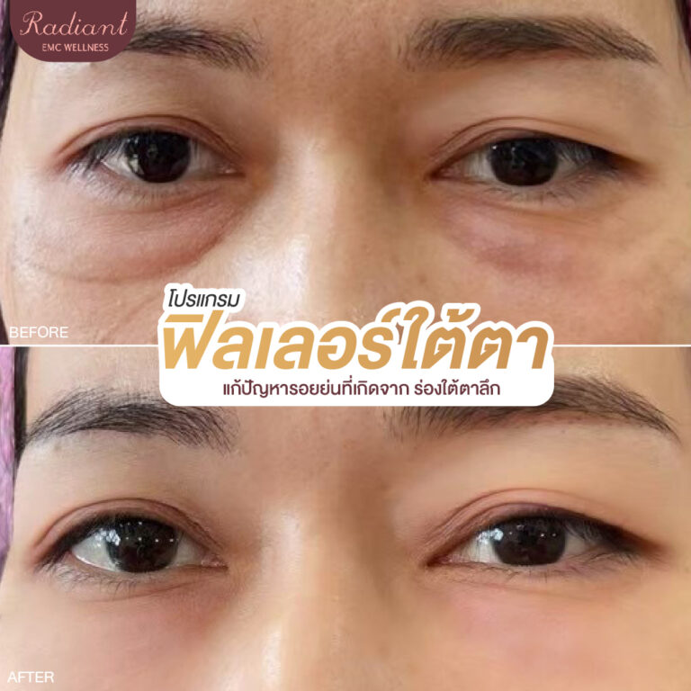 ผิวใต้ตา