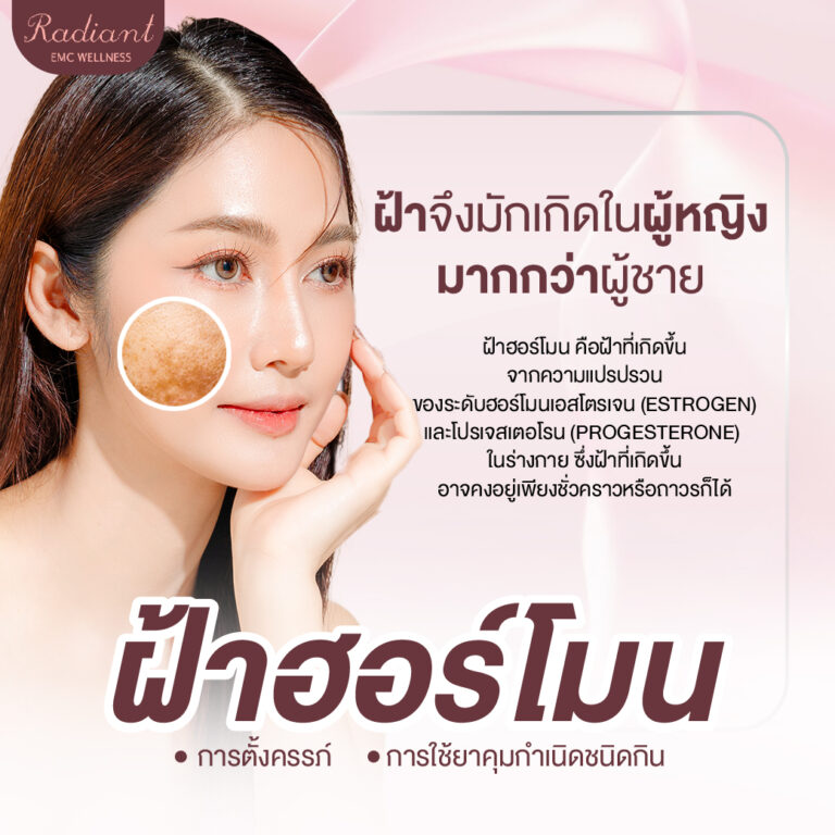 ฝ้าฮอร์โมน