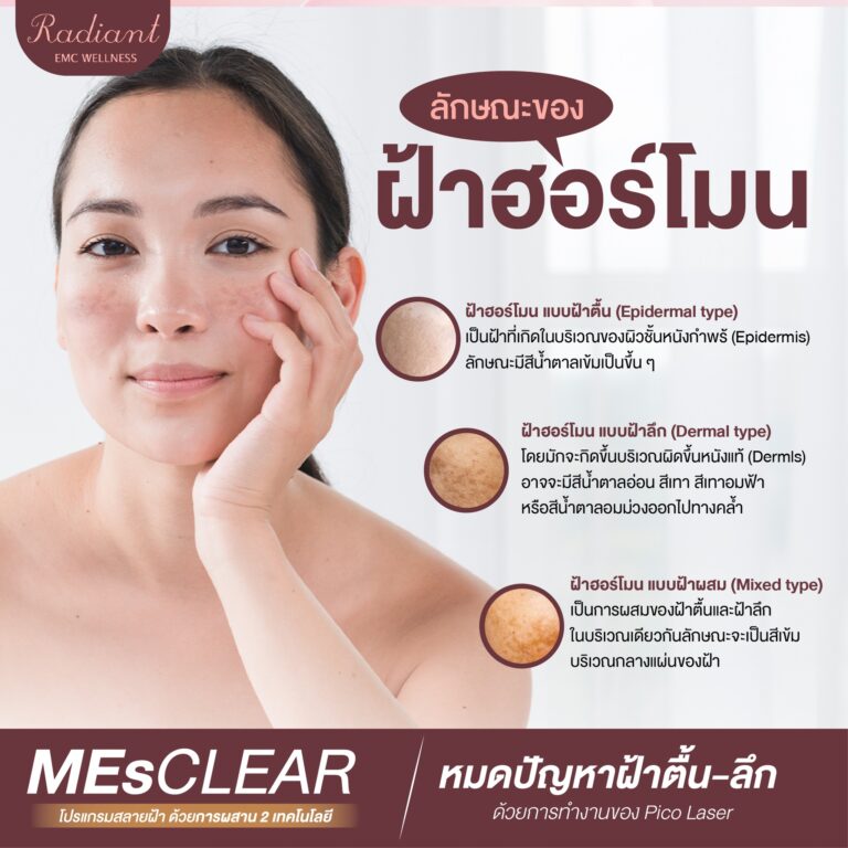 ฝ้าฮอร์โมน