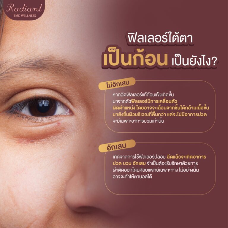 ฟิลเลอร์ใต้ตา