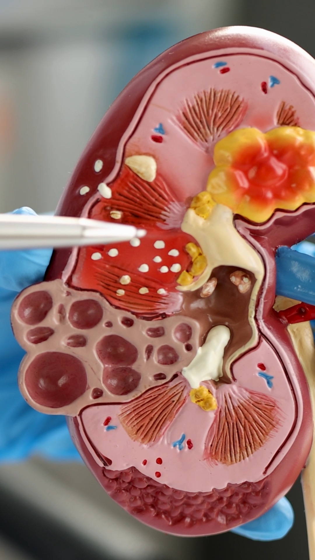 เฝ้าระวังไต