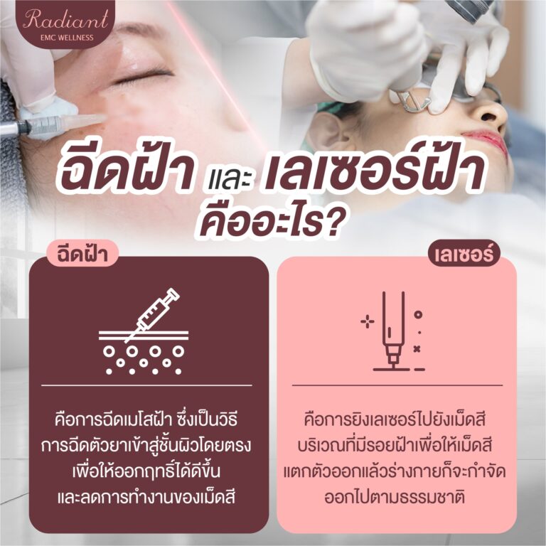 เลเซอร์ฝ้า