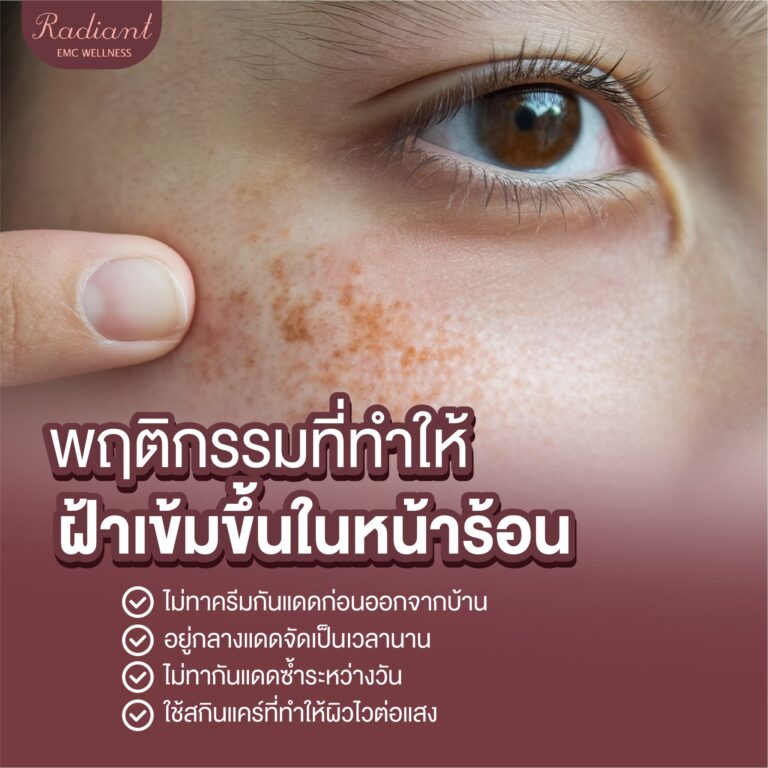 ฝ้าเข้มขึ้น