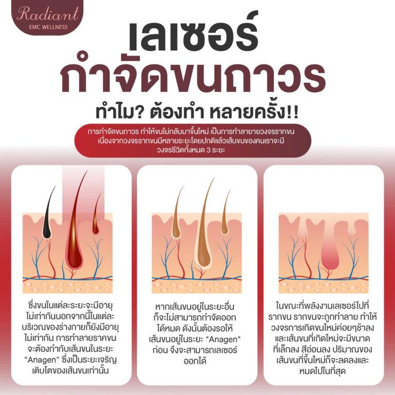 เลเซอร์กำจัดขนถาวร