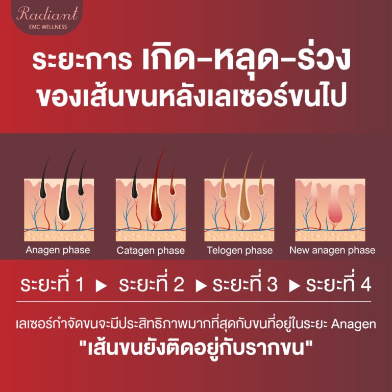 เส้นขนหลังเลเซอร์