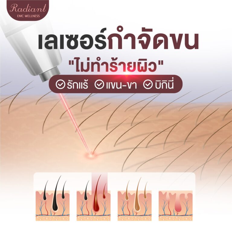 เลเซอร์กำจัดขน