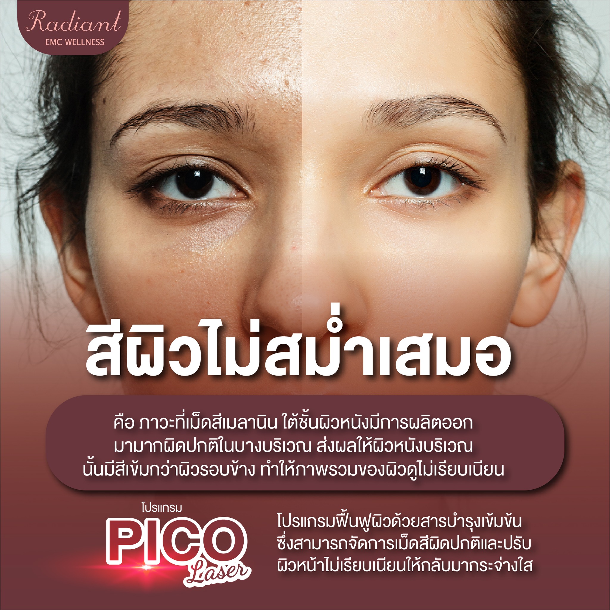 สีผิวไม่สม่ำเสมอ