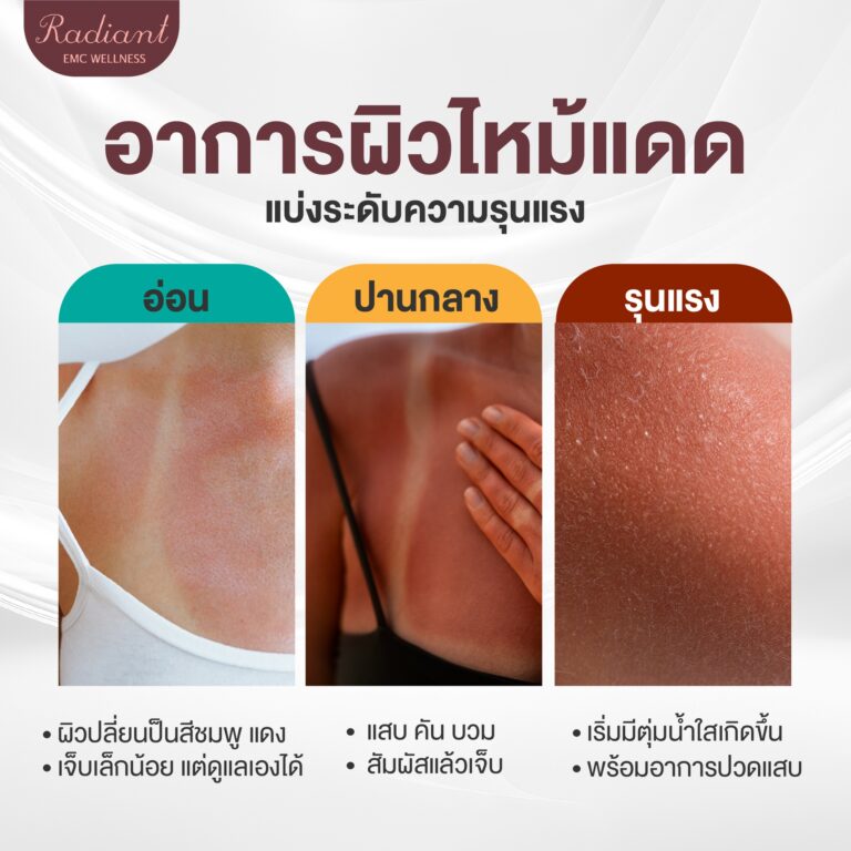 ผิวไหม้แดด