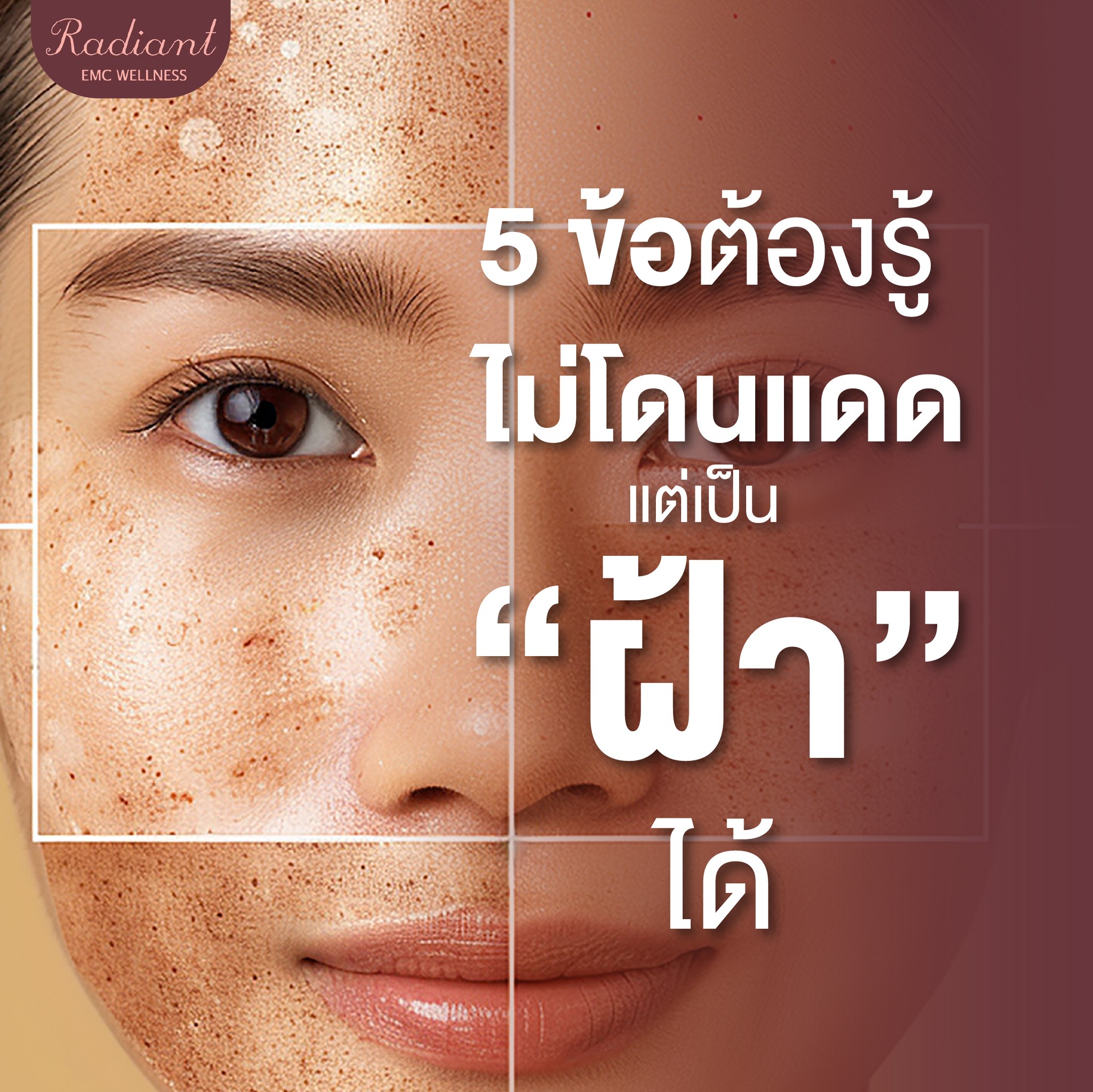 เป็นฝ้า