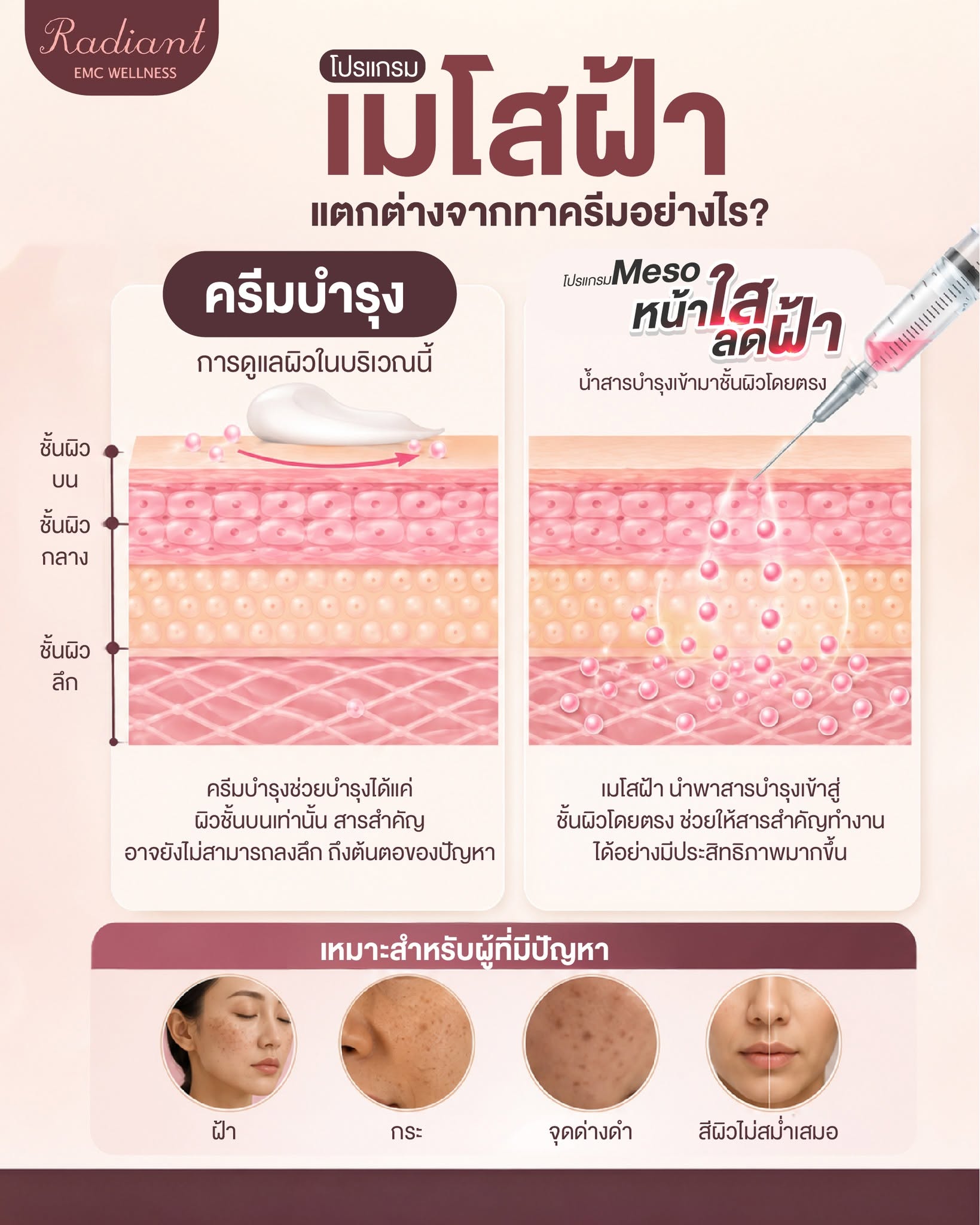 Meso ฝ้า