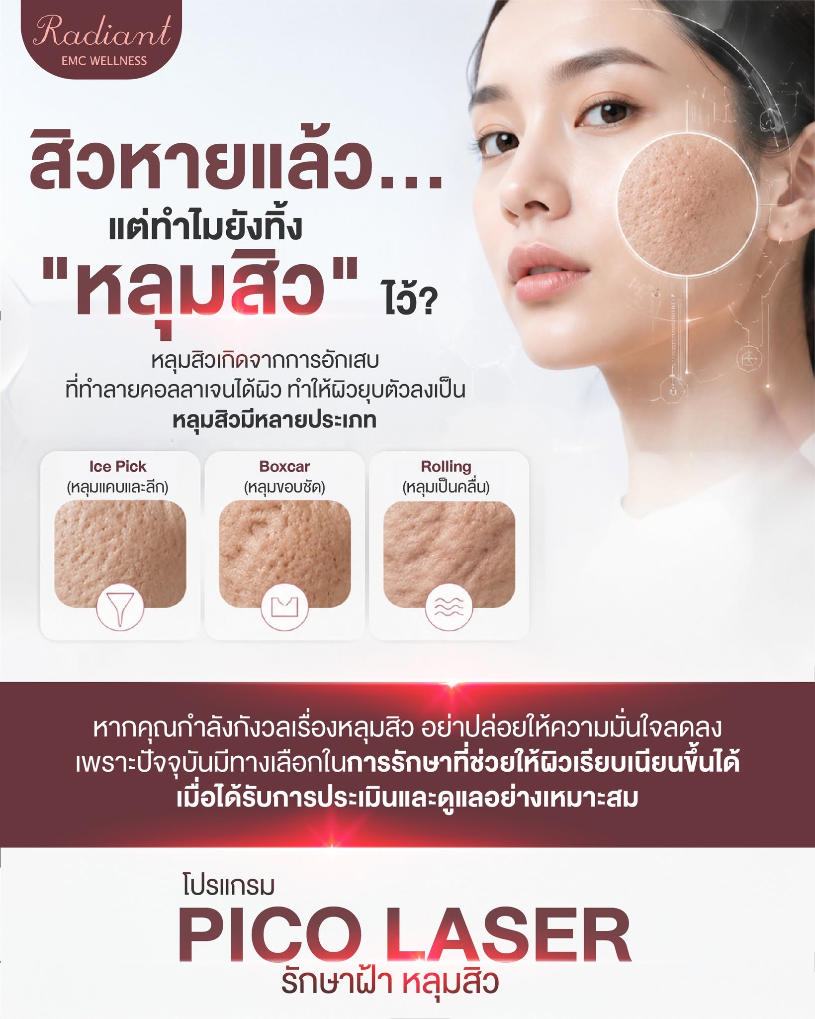 หลุมสิว