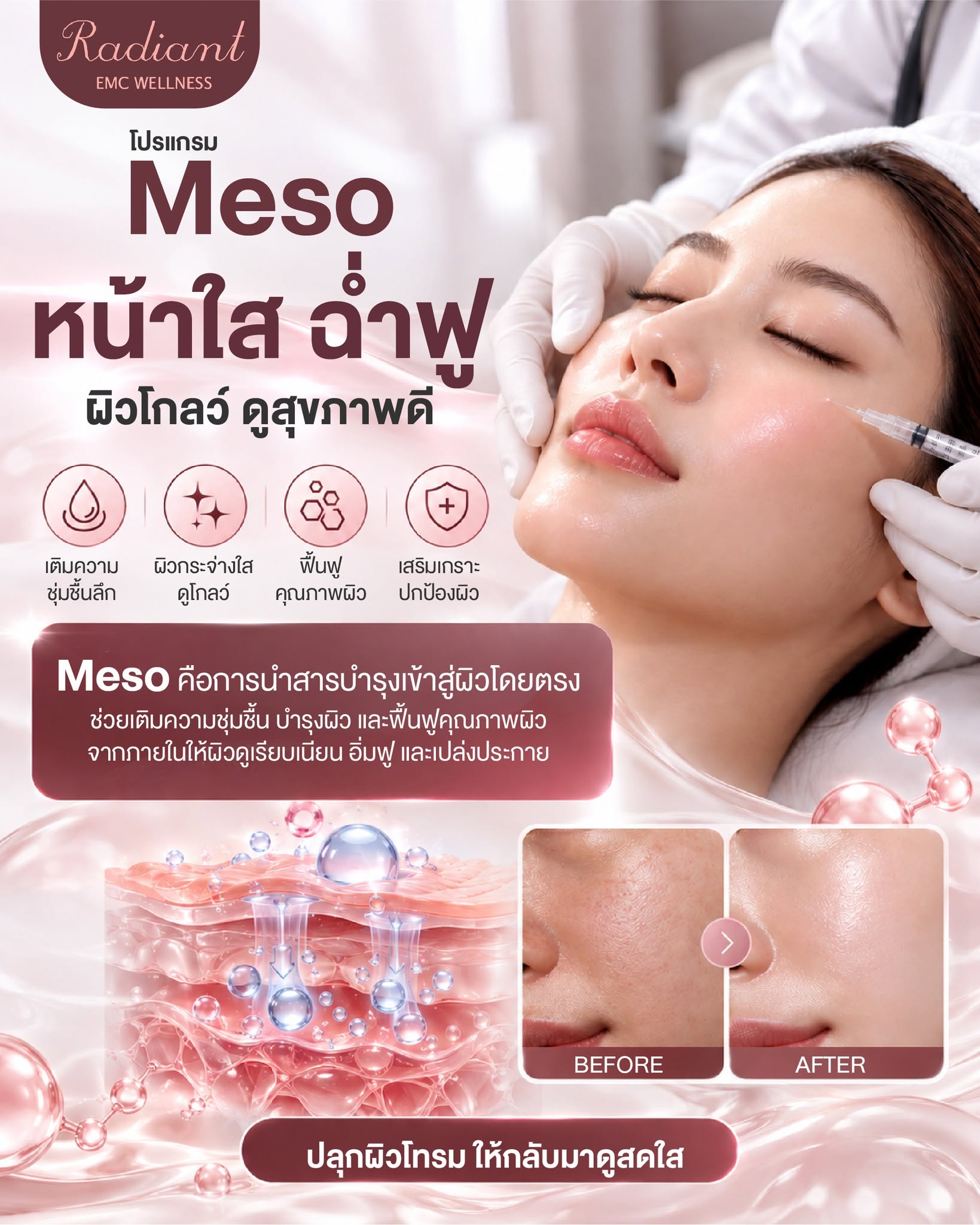 โปรแกรม MESO
